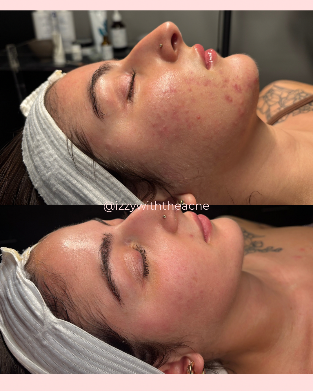 Client skin before-and-after comparison.