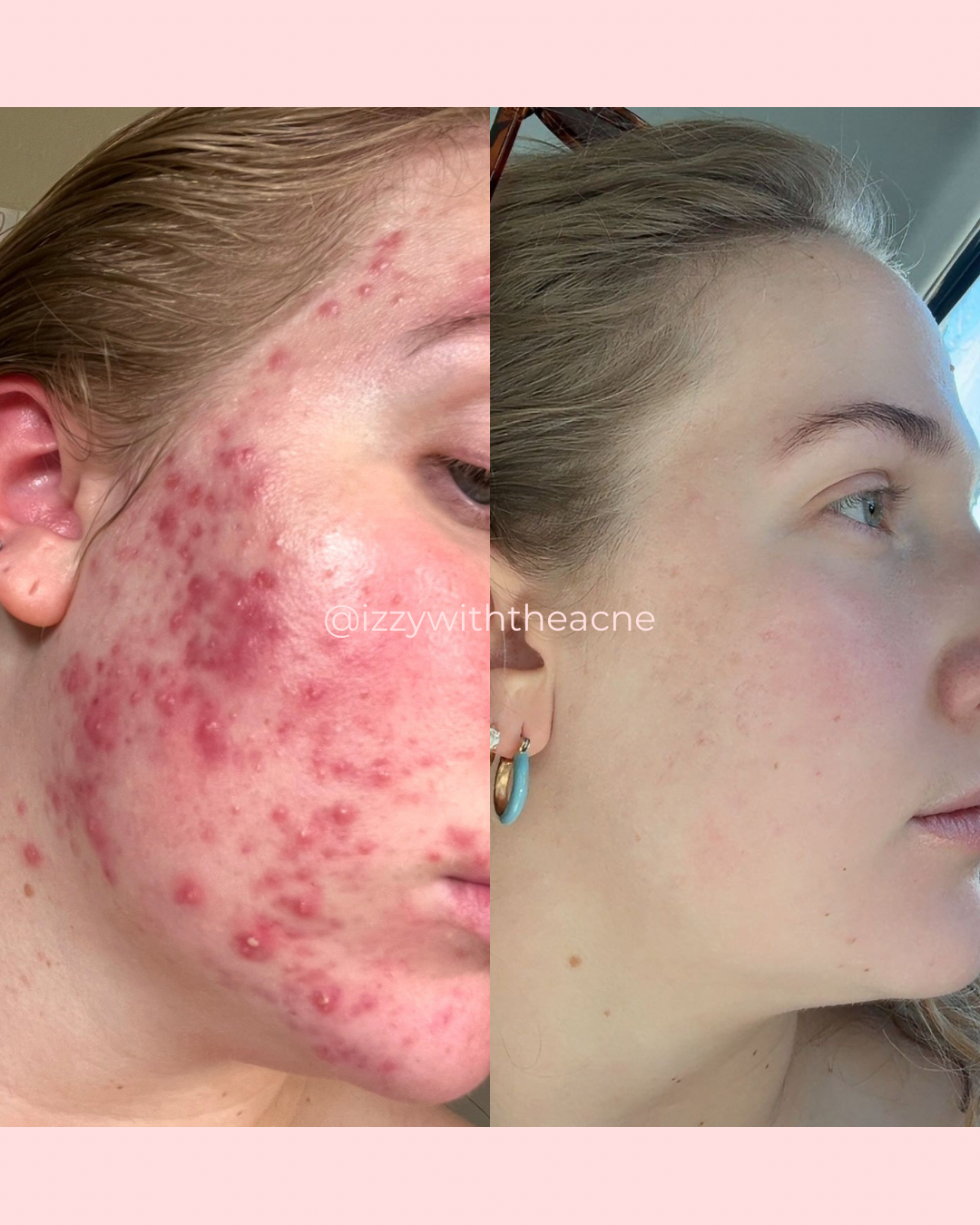 Client skin before-and-after comparison.