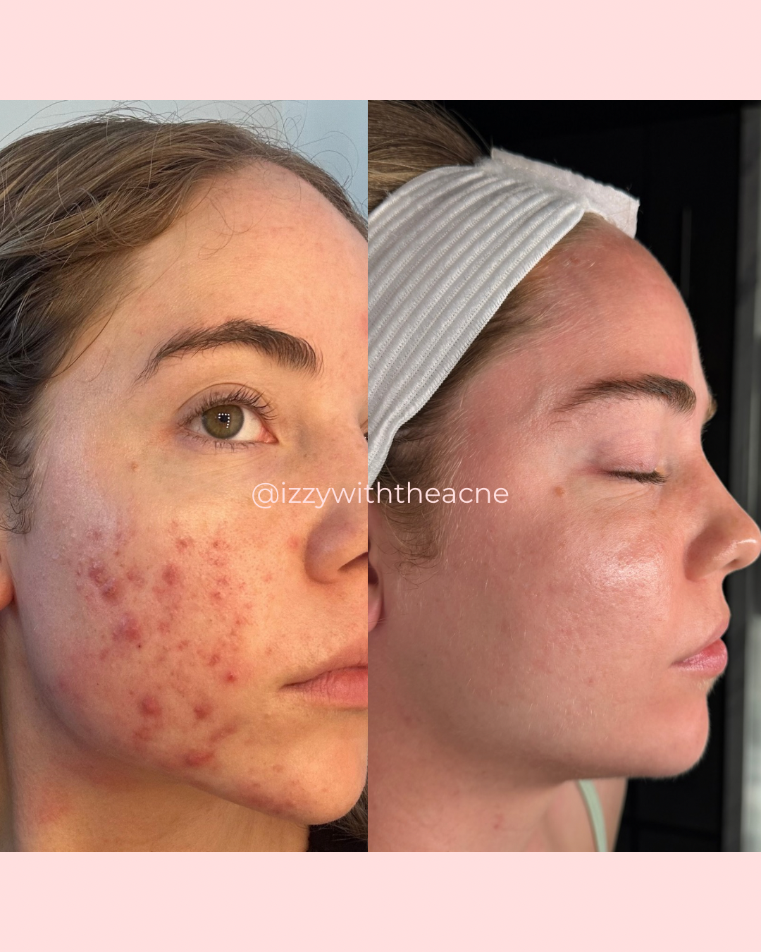 Client skin before-and-after comparison.