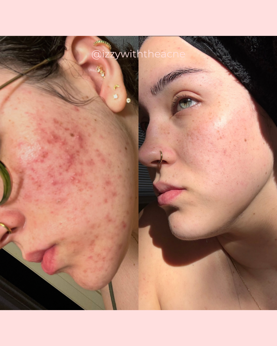Client skin before-and-after comparison.