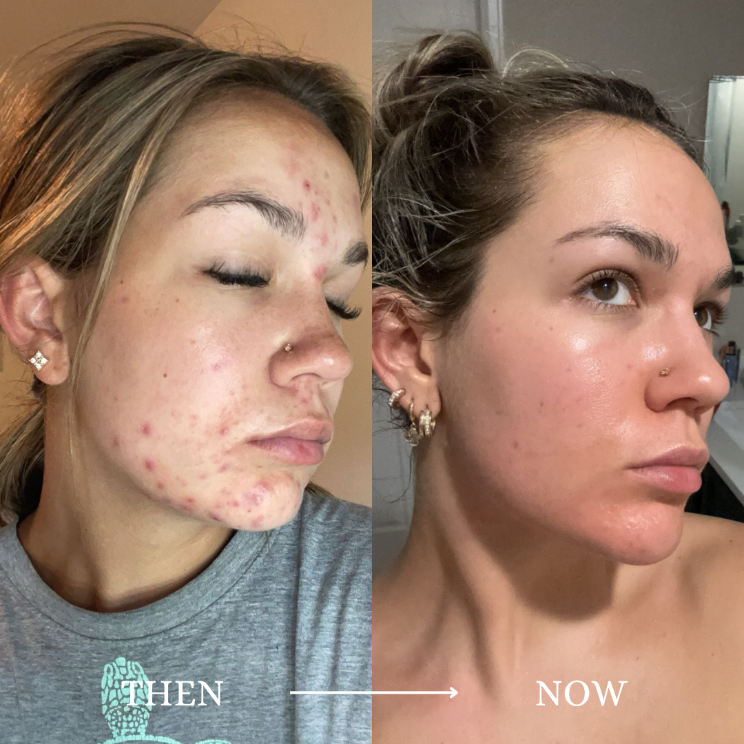 Side-by-side photographs from Isabella's personal acne journey, labeled Then and Now.