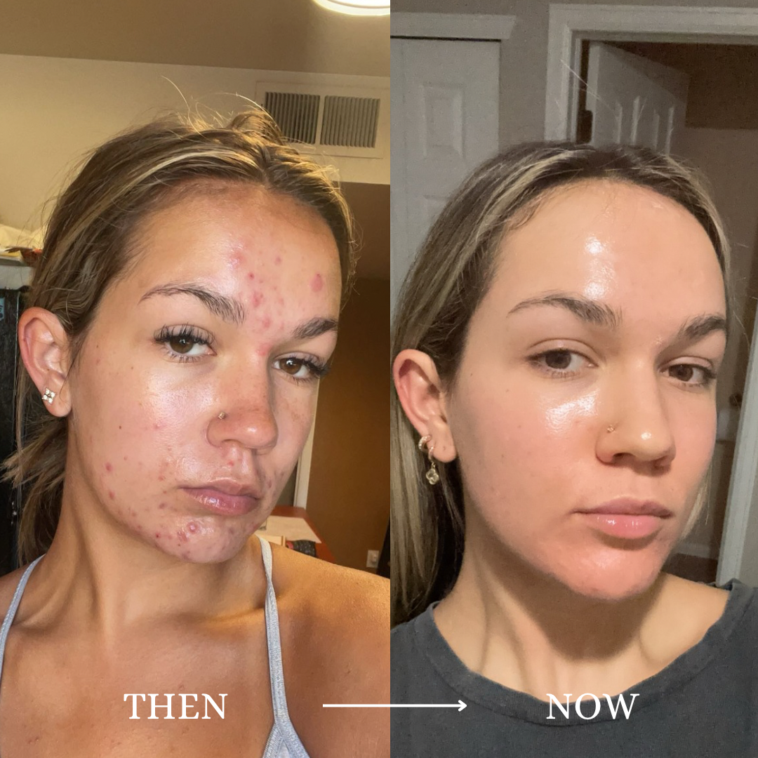 Another view from Isabella's personal acne journey, labeled Then and Now.
