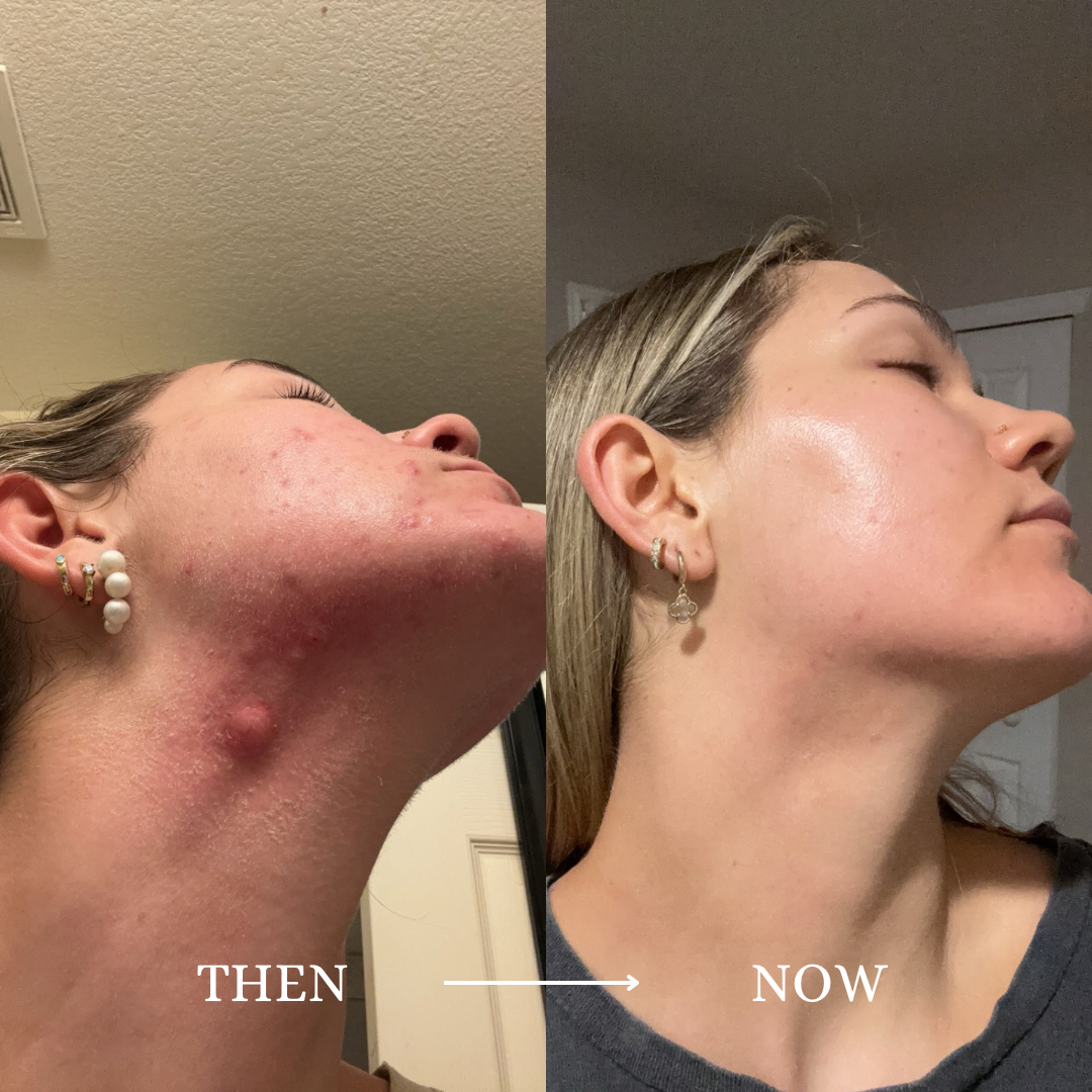 Another view from Isabella's personal acne journey, labeled Then and Now.