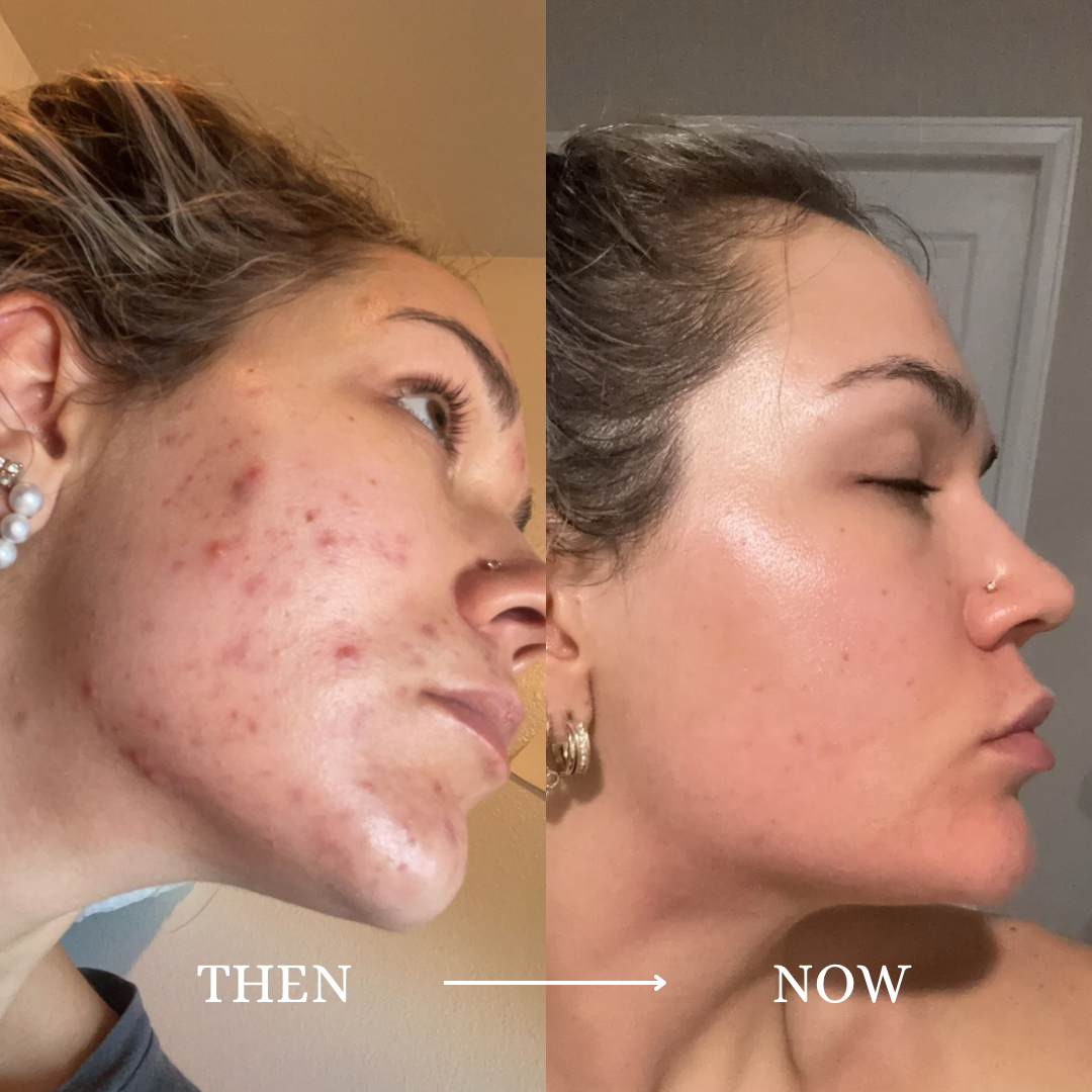 Another view from Isabella's personal acne journey, labeled Then and Now.